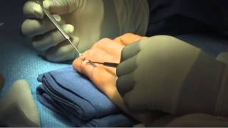 Treatment of Chronic Mallet Finger by Leo Rozmaryn MD [upl. by Nnylacissej943]