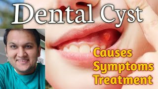 Dental Cyst and Infection Causes Symptoms Types and Treatment [upl. by Haney545]