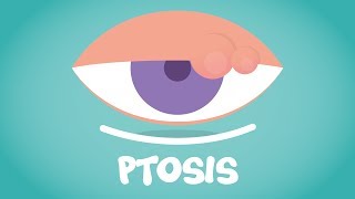 What is Ptosis [upl. by Imojean853]