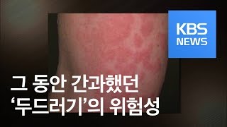 가렵고 부어오르는 두드러기 증상 그냥 두면 안 되는 이유는 with 서울대병원 알레르기내과 박흥우 교수  자이홍의 건강극장 ep11 [upl. by Aimat]