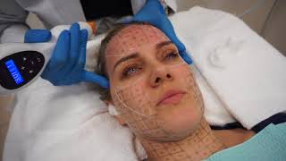 Nonsurgical skin tightening using Thermage CPT by Dr Shaun Patel in Miami FL [upl. by Hatnamas]