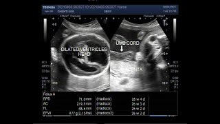 Dilated fetal ventricles Ventriculomegaly also known as hydrocephalus [upl. by Dietsche130]