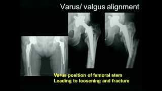 Biomechanics of the Hip Joint [upl. by Nnylak]