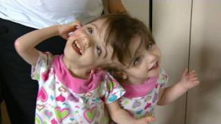 Conjoined Twins Twin Girls A Medical Wonder [upl. by Telocin2]