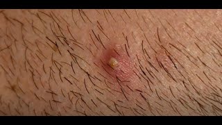 Popping ASMR Satisfying Ingrown Hair Plucking  Ingrown Hair Removal [upl. by Haramat109]