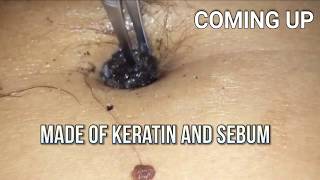 Navel Stone or Giant Belly Blackhead Bizarre Medical [upl. by Dorina10]