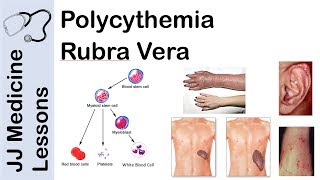 Polycythemia Rubra Vera  Pathophysiology Symptoms Diagnosis and Treatment [upl. by Raji151]