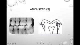 Interpretation of Dental Caries Source [upl. by Aidil]