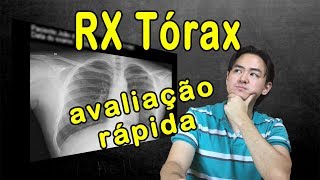 Raio X Tórax  Avaliação rápida [upl. by Anires]