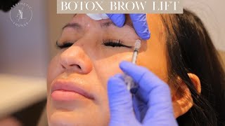 Botox Brow Lift [upl. by Aisatsanna]