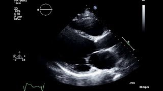 Ischemic Cardiomyopathy 2D Echocardiogram [upl. by Avilo561]