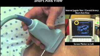 How To Ultrasound Guidance for Central Venous Access Part 1 Case Study [upl. by Hailat]