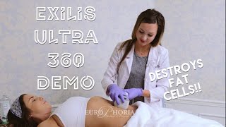 EXILIS ULTRA DEMONSTRATION BODY  Exilis Ultra 360 Experience at EuroPhoria [upl. by Faletti]