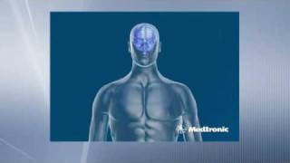 Deep Brain Stimulation  How does DBS work [upl. by Ronyam125]