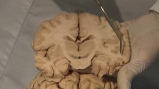 Cortical Localization Neuroanatomy Video Lab  Brain Dissections [upl. by Otiv]