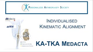 KATKA Medacta Individualised Kinematic Alignment [upl. by Viddah]