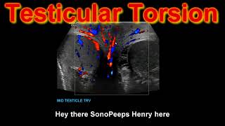 Testicular Torsion  Necrotic [upl. by Ielirol]