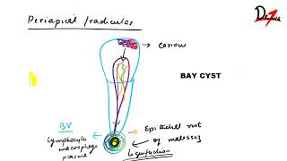 Radicular cyst  PATHOGENESIS CF RF amp TREATMENT [upl. by Jansen934]