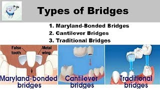 Types Of Dental Bridges [upl. by Neyud390]