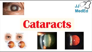 Cataracts  Causes Risk factors Subtypes Cortical Nuclear Posterior subcapsular Treatment [upl. by Costa]