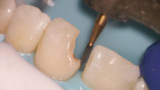 Teeth Bonding  Front tooth filling EXPLAINED [upl. by Malorie364]