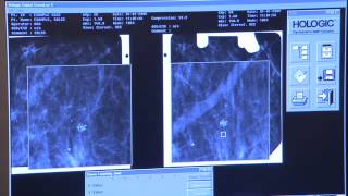 Radiation Therapy to Treat Breast Cancer Options Duration and Side Effects [upl. by Acirem]