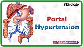 Portal hypertension USMLE Step 1  Etiology Clinical features Diagnosis and Treatment [upl. by Naehgem]