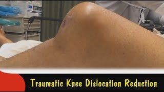 Traumatic Knee Dislocation Reduction [upl. by Yeta]