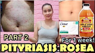 PITYRIASIS ROSEA WHAT’S MY STORY PHILIPPINES [upl. by Henry]