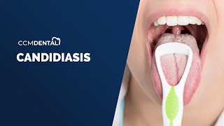 Candidiasis Oral  Síntomas causas y tratamiento por Javier Alberdi CCM Dental [upl. by Deonne253]