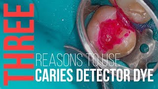 3 Reasons to Use Caries Detector Dye [upl. by Etienne]