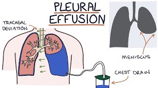 Understanding Pleural Effusions [upl. by Goodrow]