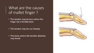 Mallet Finger Explained by Dr Alexander Anzarut [upl. by Atener577]