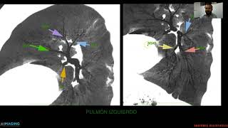 Anatomía Radiológica del Tórax [upl. by Nett84]