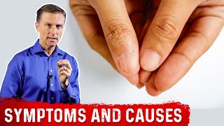 Iron Deficiency Symptoms and Causes of Anemia – DrBerg [upl. by Sayed996]