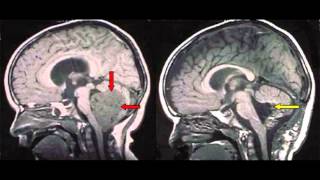 Brain Tumor Overview [upl. by Fredel242]