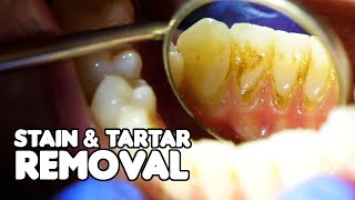 Dental Cleaning EXPLAINED  Stain amp Tartar Removal [upl. by Gnot]