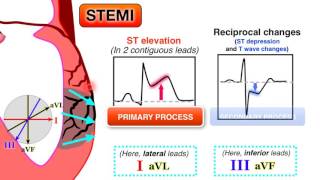 Ischemia 67  STEMI on ECG [upl. by Sorel]