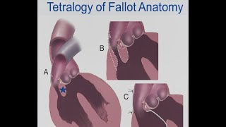 Jasmine S  Heart Surgery Saves MicroPreemie with Tetralogy of Fallot [upl. by Ennairak359]