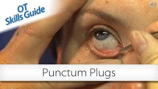 OT skills guide punctum plugs [upl. by Rusticus988]