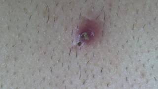 BLACKHEAD or INGROWN HAIR [upl. by Alexine]