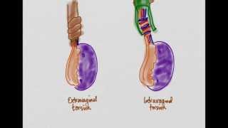 Testicular Torsion [upl. by Ambur83]