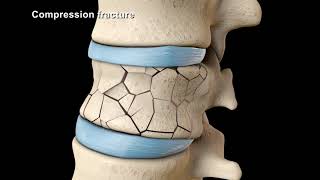 Vertebroplasty amp Kyphoplasty Demonstration by Glen David MD [upl. by Bess]