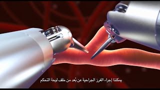 Totally Endoscopic Robotic Coronary Bypass TECAB [upl. by Dugan]