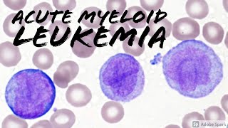 Acute Myeloid Leukemia AML w Monocytic Differentiation formerly AMML with Blasts amp Promonocytes [upl. by Aihsiym]