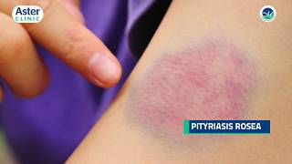 Dr Srinivasa Munivenkatappa talks about Pityriasis Rosea [upl. by Fasto]