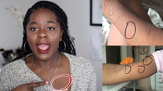 My Skin Story  How I got rid of Pityriasis Rosea  TheAdeTomi [upl. by Lordan]