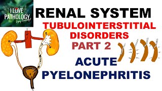 ACUTE PYELONEPHRITIS Pathology [upl. by Sill468]