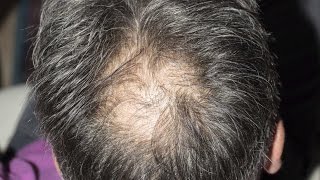 This is how stress affects hair loss [upl. by Adeys]