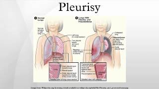 Pleurisy [upl. by Zurkow119]